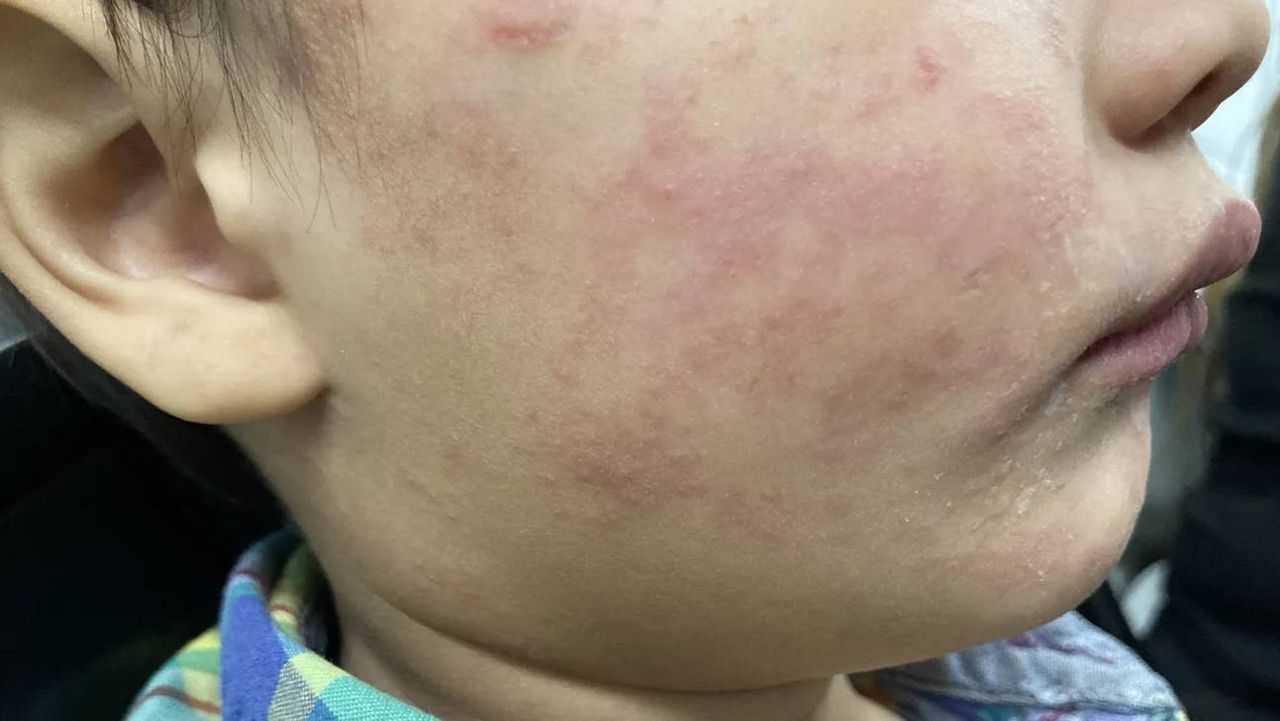 health-commissioner-warns-of-vaccine-confusion-amid-measles-outbreak