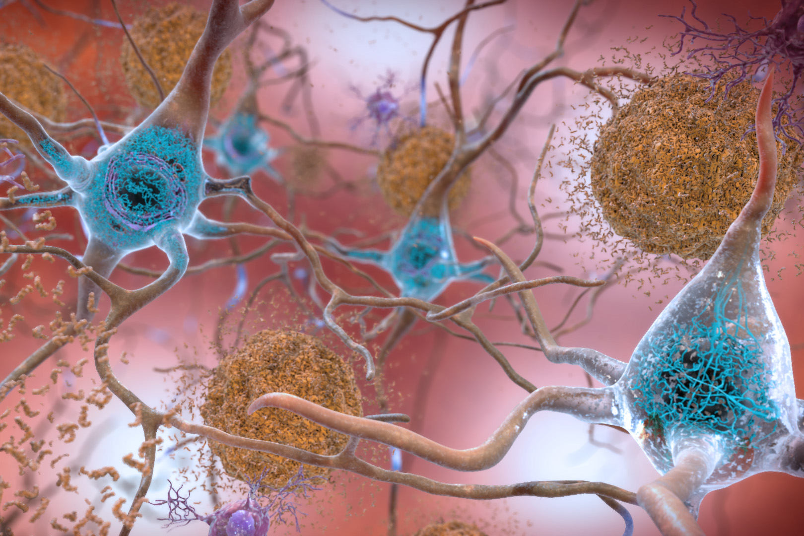 study-explains-how-a-rare-gene-variant-contributes-to-alzheimer’s-disease