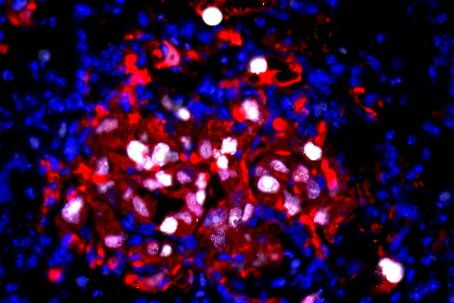 inflammation-jolts-“sleeping”-cancer-cells-awake,-enabling-them-to-multiply-again