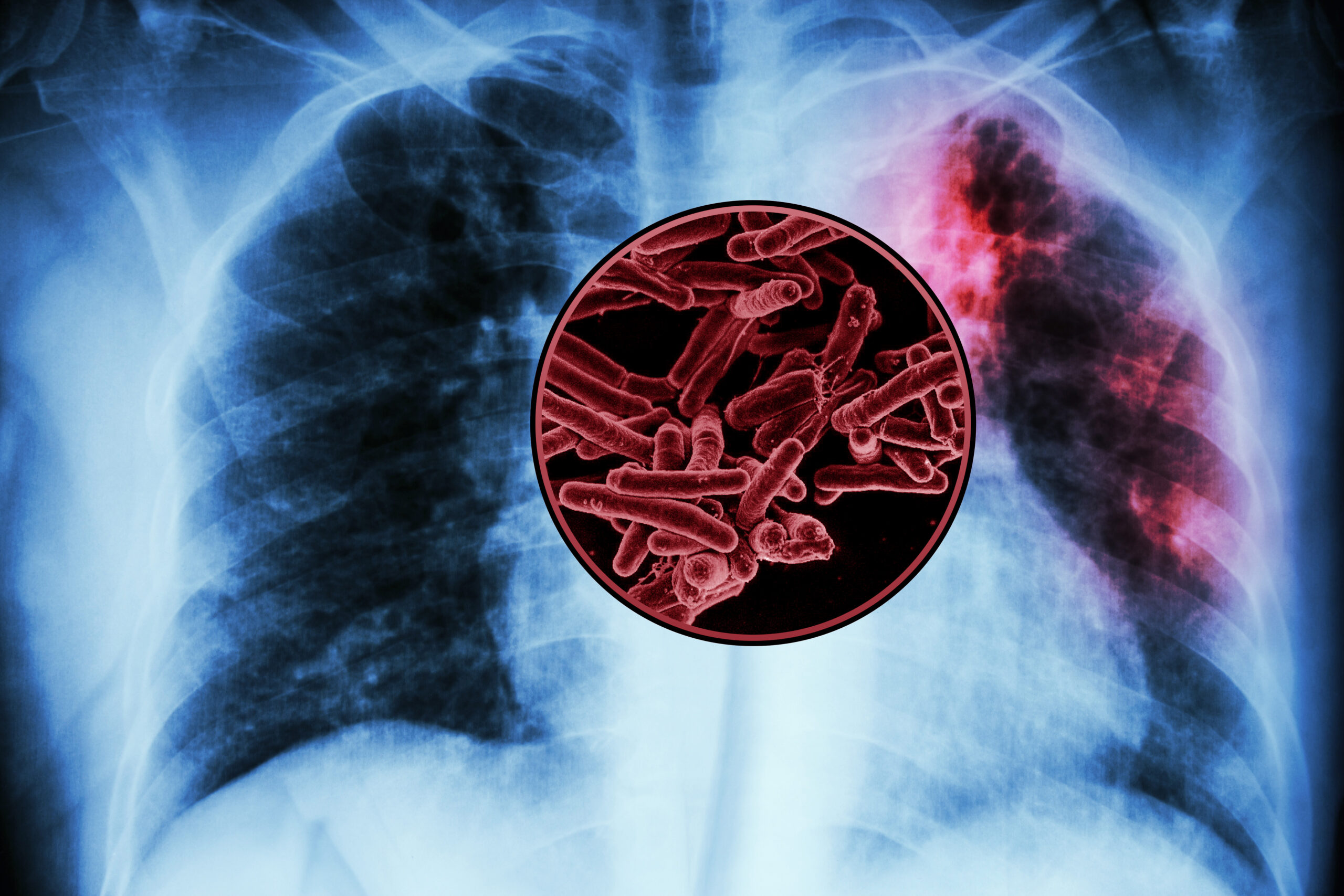 mit-study-finds-targets-for-a-new-tuberculosis-vaccine