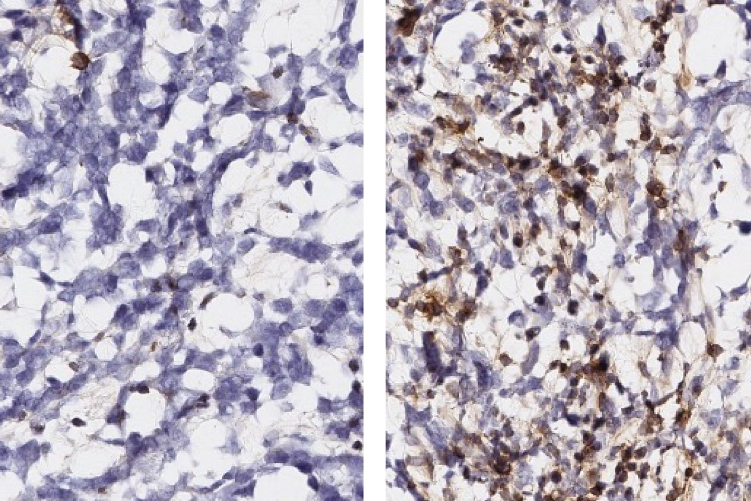 mit-researchers-find-new-immunotherapeutic-targets-for-glioblastoma